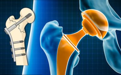 Trial Aims to Improve Hip Replacement Outcomes 